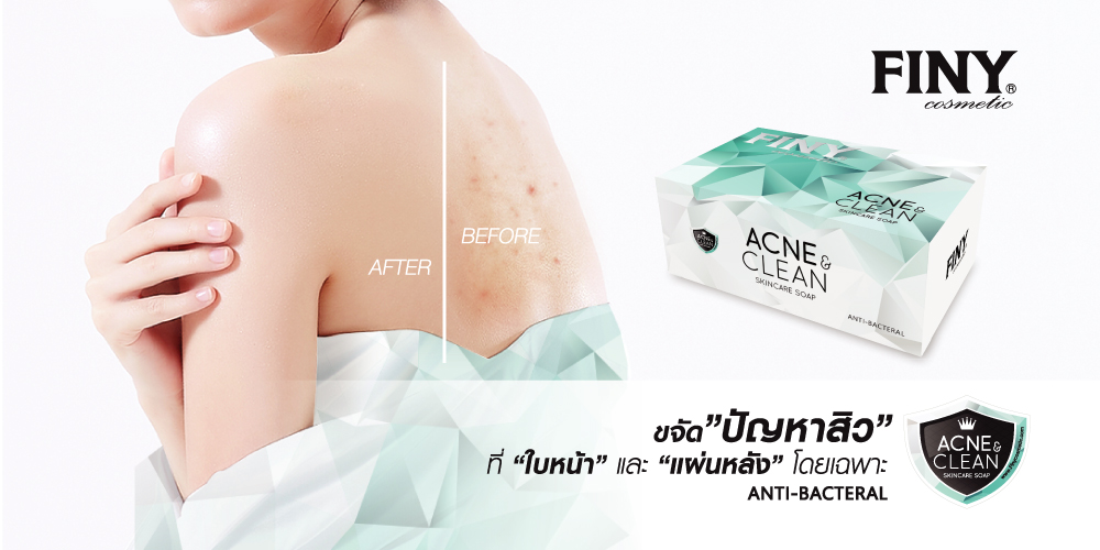 สบู่สิว,แก้ปัญหาสิวที่หลัง,สิวที่หลัง,ลดสิว,กำจัดสิว,เจลล้างหน้า,เจลล้างหน้าสิว,สิว,ล้างสิว,กำจัดสิว,ล้างสิวออก,ล้าวผิว,เจลล้างหน้าสิวหลุด,สิวผด,สิวเม็ดใหญ่,สิวหาย,ครีมหน้าใส,ฝ้าขาว,ครีมฟ้าขาว,หน้าใส,ครีมบำรุง,ลดฝ้า,เซรั่ม,ผิวหน้าขาว,ครีมทาฝ้า,ครีมลดฝ้า,ฝ้าหาย,ขาวครีม,ลดกระ,ซีรั่ม,ครีมฟ้าขาวหน้าใส,ผิวหน้าขาว,หน้าขาว,ครีมลดกระ,หน้าใส,กระ,ครีมหน้าขาว,หน้าใส,ครีมฟ้าขาวของแท้,รักษาสิว,สิวหาย,ลดสิว,สิวอุดตัน,สิว,หน้าตึง,ขาวหน้า,ครีมทาหน้า,ครีมบำรุงผิว,เซรั่มวิตามินซี,เซรั่มบำรุงหน้า,โฟมล้างหน้า,สบู่วิตามินซี,สบู่นำเข้า,facial soap,Acne Clear,ครีมกันแดด,ผิวกระจ่างใส,ครีมกันแดดทาหน้า,ฟินนี่,คอสเมติกส์