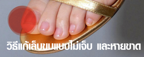 วิธีแก้เล็บขบ แบบไม่เจ็บ! และให้หายขาด โดยที่ไม่ต้องเอาเล็บออก วันนี้เราขอแนะนำ 6 สูตรสมุนไพรแก้เล็บขบ วิธีรักษาง่ายๆด้วยตัวคุณเองมาฝากกันค่ะ